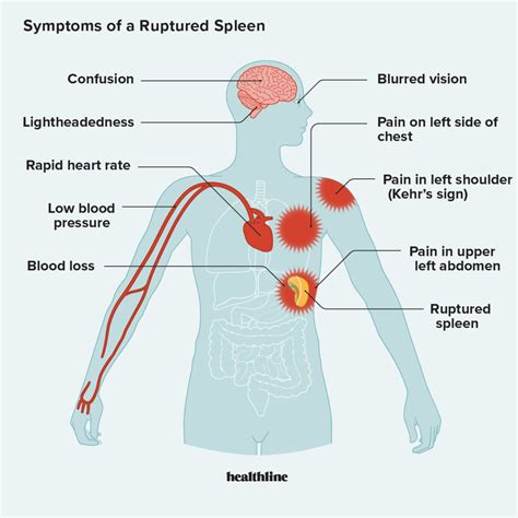 Symptoms of a Ruptured Spleen and When to Seek Help