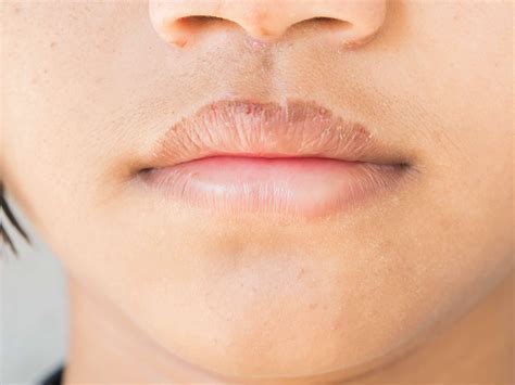 How Do I Get Rid Of Severely Chapped Lips in 2020 | Chapped lips, Sore ...