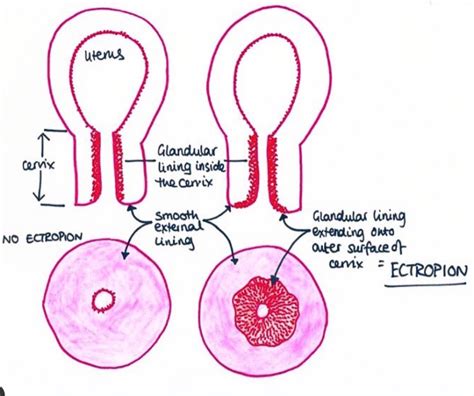 Cervical Ectropion Cervix