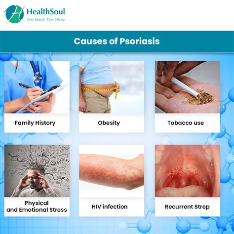 Psoriasis – Causes, Symptoms, Diagnosis, Treatment – Healthsoul