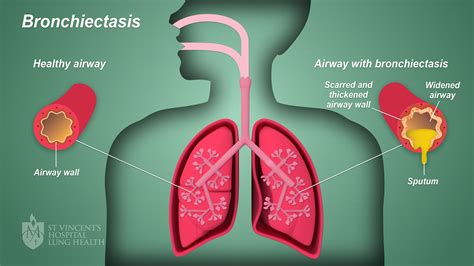 Bronchiectasis - St Vincent's Lung Health