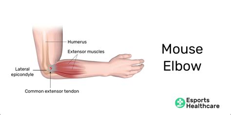 Tendinopathy from gaming: eliminating the #1 career killing ailment ...