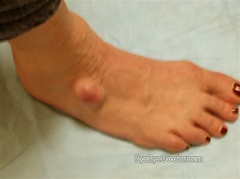 Ganglion Cyst Foot – Pictures, Symptoms, Surgery, Treatment, Removal