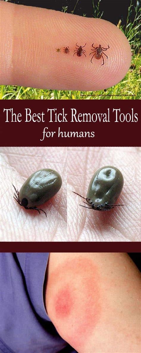 The Best Tick Removal Tools for Humans - Mom Goes Camping