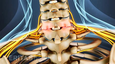 What You Need to Know about Neck Arthritis