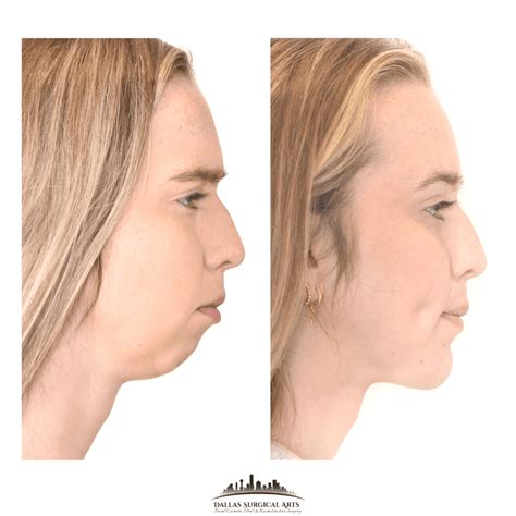 Genioplasty Explained: What to Expect from Chin Surgery in Dallas