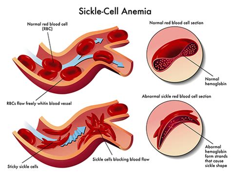 Exciting Advancements Made on Sickle Cell Anemia | Cryo-Cell