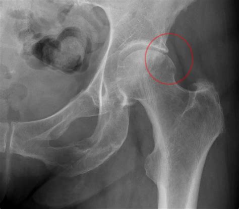 Femoroacetabular impingement: Hip disorder (explanation) | Lombafit