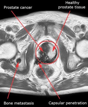 Prostate Mri Scan