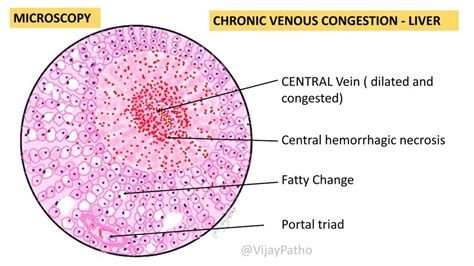 Chronic Venous Congestion - Liver - Pathology Made Simple