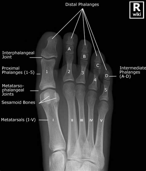 Toes Radiographic Anatomy - wikiRadiography | Radiology, Human anatomy ...