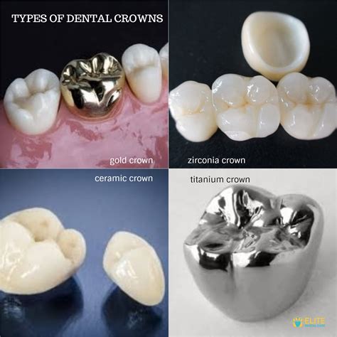 TYPES OF DENTAL CROWNS FOR DIFFERENT PATIENTS - ELITE DENTAL CARE TRACY ...