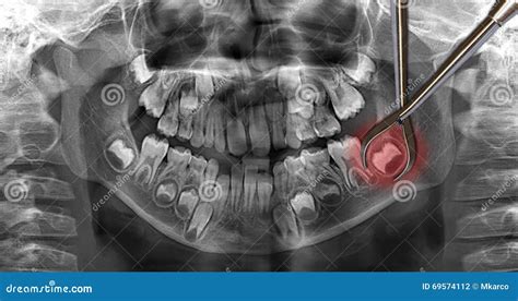 X-ray Of Deciduous Teeth, Milk Teeth Stock Photo - Image: 69574112