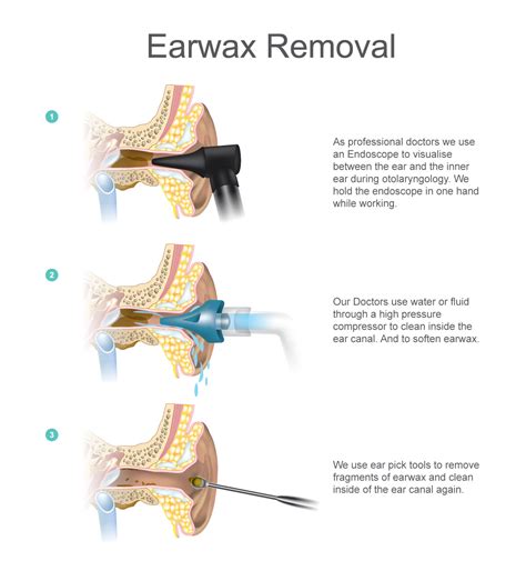 Ear Wax Removal London | Ear Microsuction | London Hearing