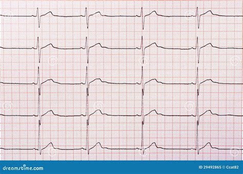 Heart Rhythm Chart Royalty-Free Stock Photography | CartoonDealer.com ...