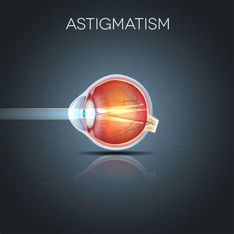 Ten things to Know about Astigmatism - Better Vision Guide