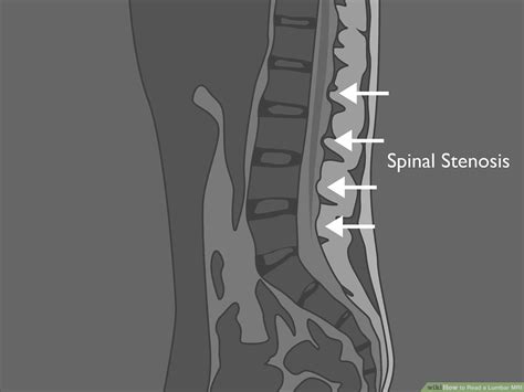 Normal Vs Abnormal Mri Lumbar Spine