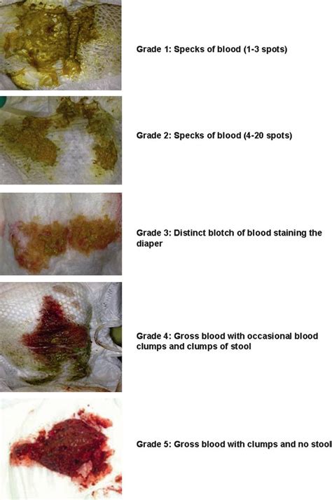 Red Blood Clot In Stool