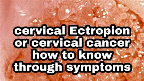 Cervical Ectropion Cervix