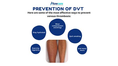 Prevention of DVT | DVT Precautions | Deep Vein Thrombosis Treatment