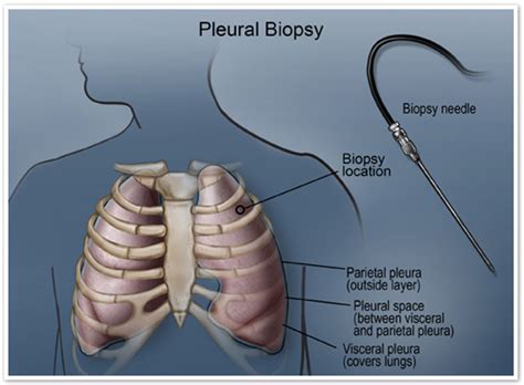 Pleural Biopsy - Soraya Detlef Blog