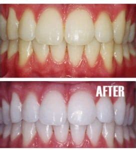 teeth-whitening-before-and-after-up-and-down - Winchester Dental