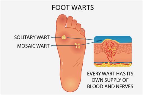 Plantar Warts Foot And Ankle Podiatrists, 47% OFF