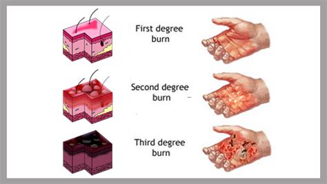 Texas Burn Injury Attorney - Third-Degree Burns