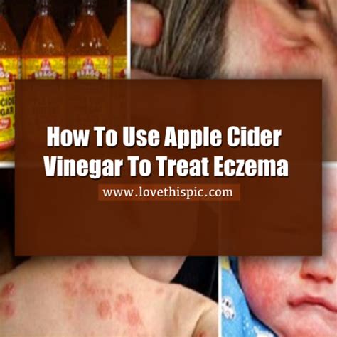 How To Use Apple Cider Vinegar To Treat Eczema