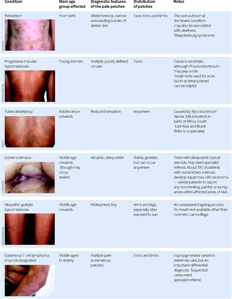 Hypopigmentation On Face