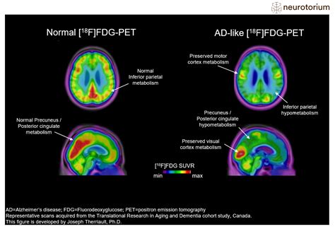 PET imaging of brain metabolism in Alzheimer's disease - Neurotorium