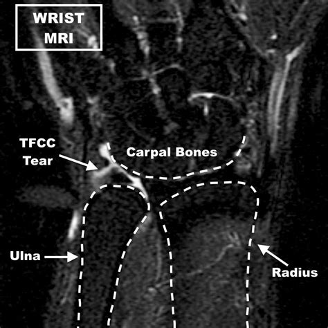 Tfcc Tear Mri - Goimages Inc