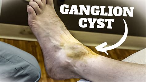 Ganglion Cyst Foot Surgery Recovery Time [Causes & Best Treatment]