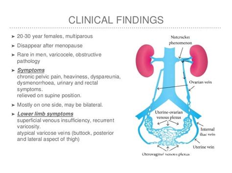 Pelvic Congestion Syndrome