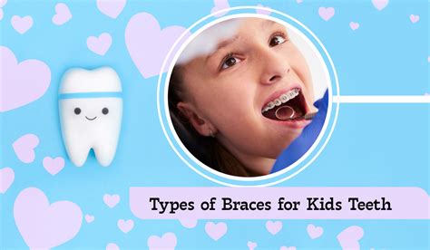 Exploring the Different Types of Braces for Kids Teeth