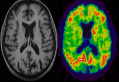 MRI-PET scanner will enable new insights into dementia | Imperial News ...