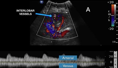 VExUS Ultrasound Score – Fluid Overload and Venous Congestion ...