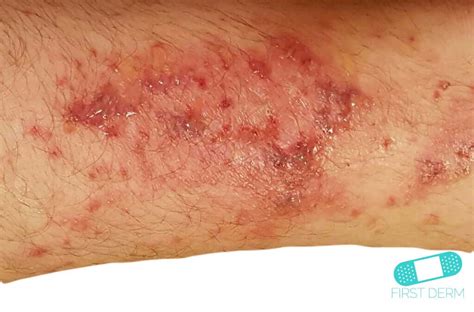 Online Dermatology - Impetigo (School Sores)