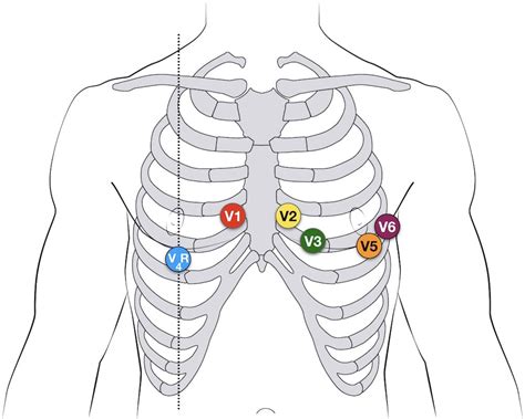 Paediatric ECG lead placement • LITFL • ECG Library Diagnosis