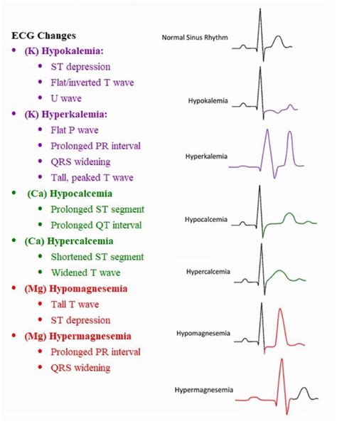 Ecg Abnormalities Chart Oficial Online | www.gbu-hamovniki.ru