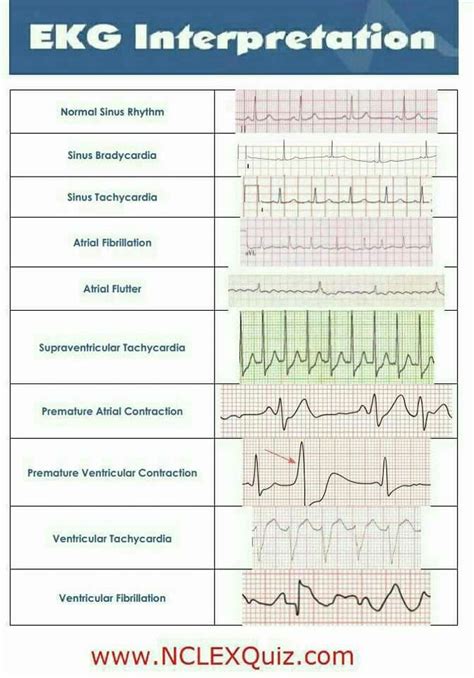 ECG Nursing Mnemonics - Bing | Ecg nursing, Nursing mnemonics, Ekg ...