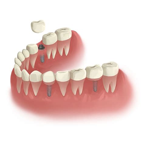 The Benefits of Wisdom Teeth Removal – avilamistica