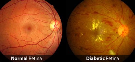 Diabetic Eye Disease Raleigh | Routine Eye Exams Clayton, NC