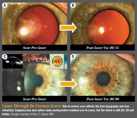 Corneal Scar Surgery Jacksonville | Gulani Vision