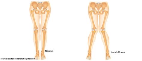 Knock Knees- Everything you need to know - Young Bones Clinic