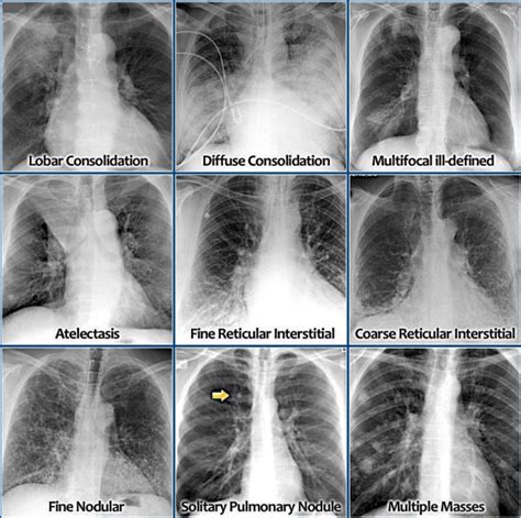 Chest X Ray Pleural Effusion Interpretation