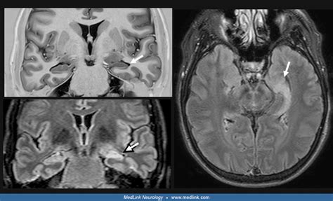 Hippocampal Atrophy In Epilepsy | MedLink Neurology