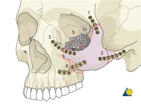 Maxillofacial Trauma: Orbital Fracture