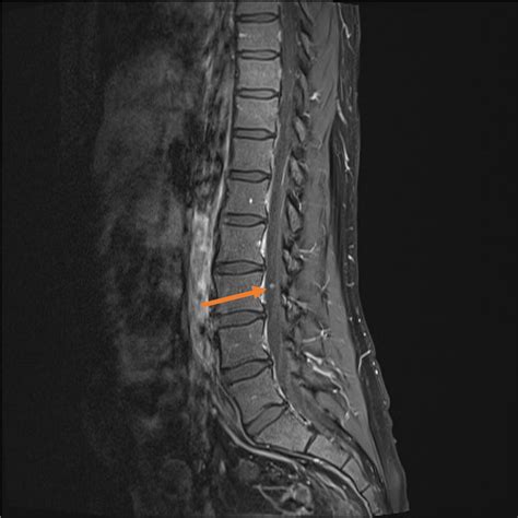 Lumbar Spine Mri Labeled