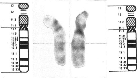 Chromosome 22 photomicrographs from case 2 with adjacent ideograms. The ...